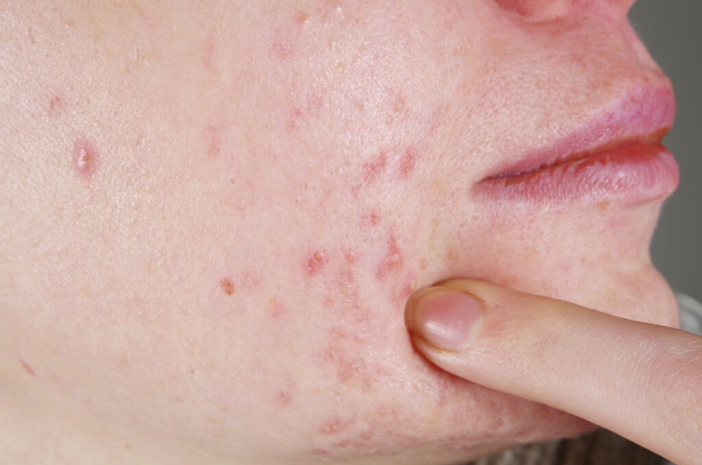 adult acne