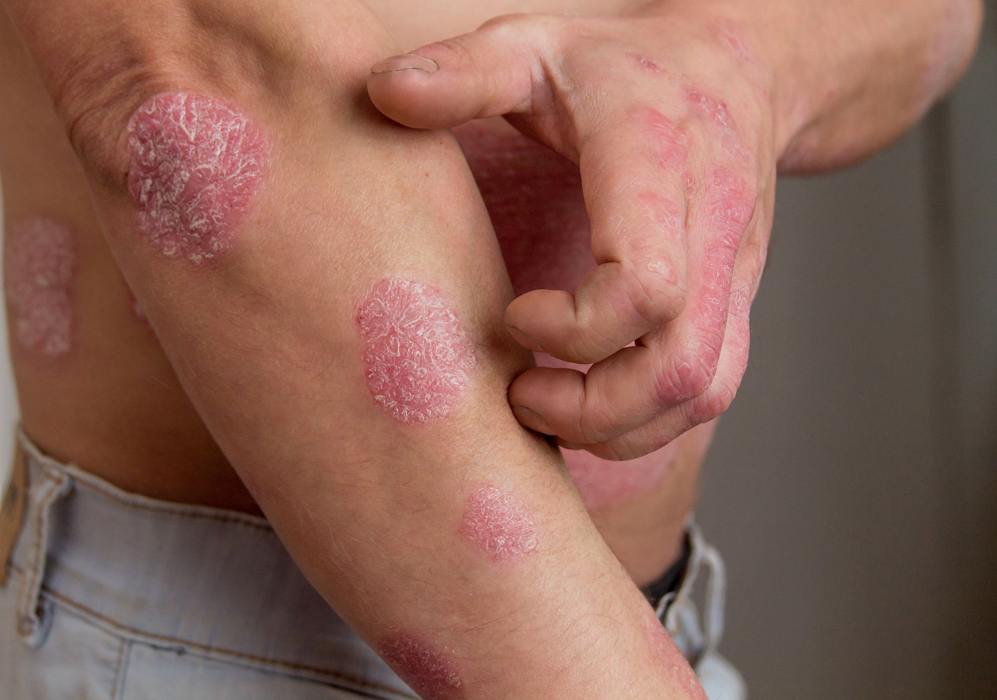 how to stop eczema itching immediately