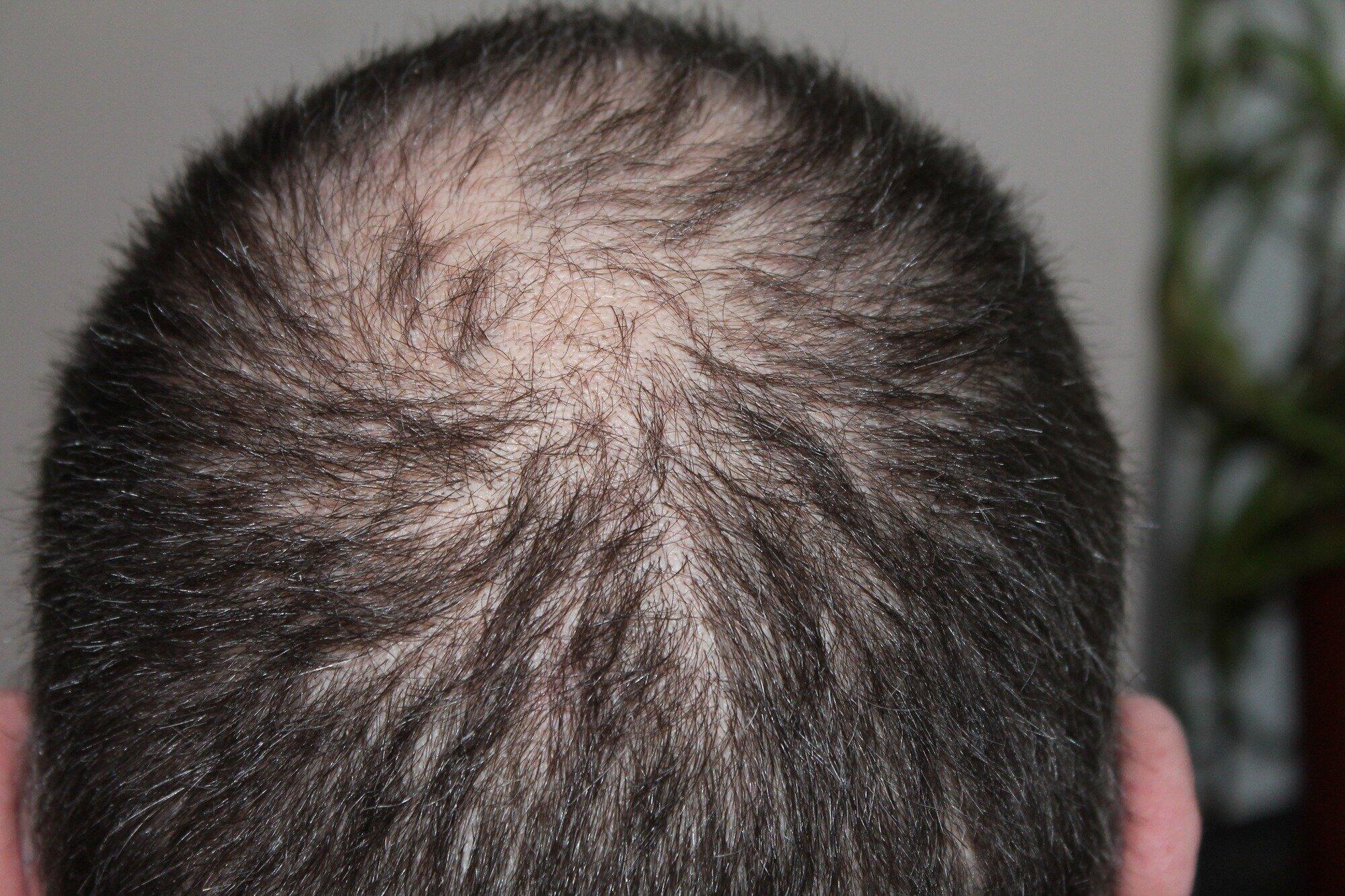 nizoral hair loss