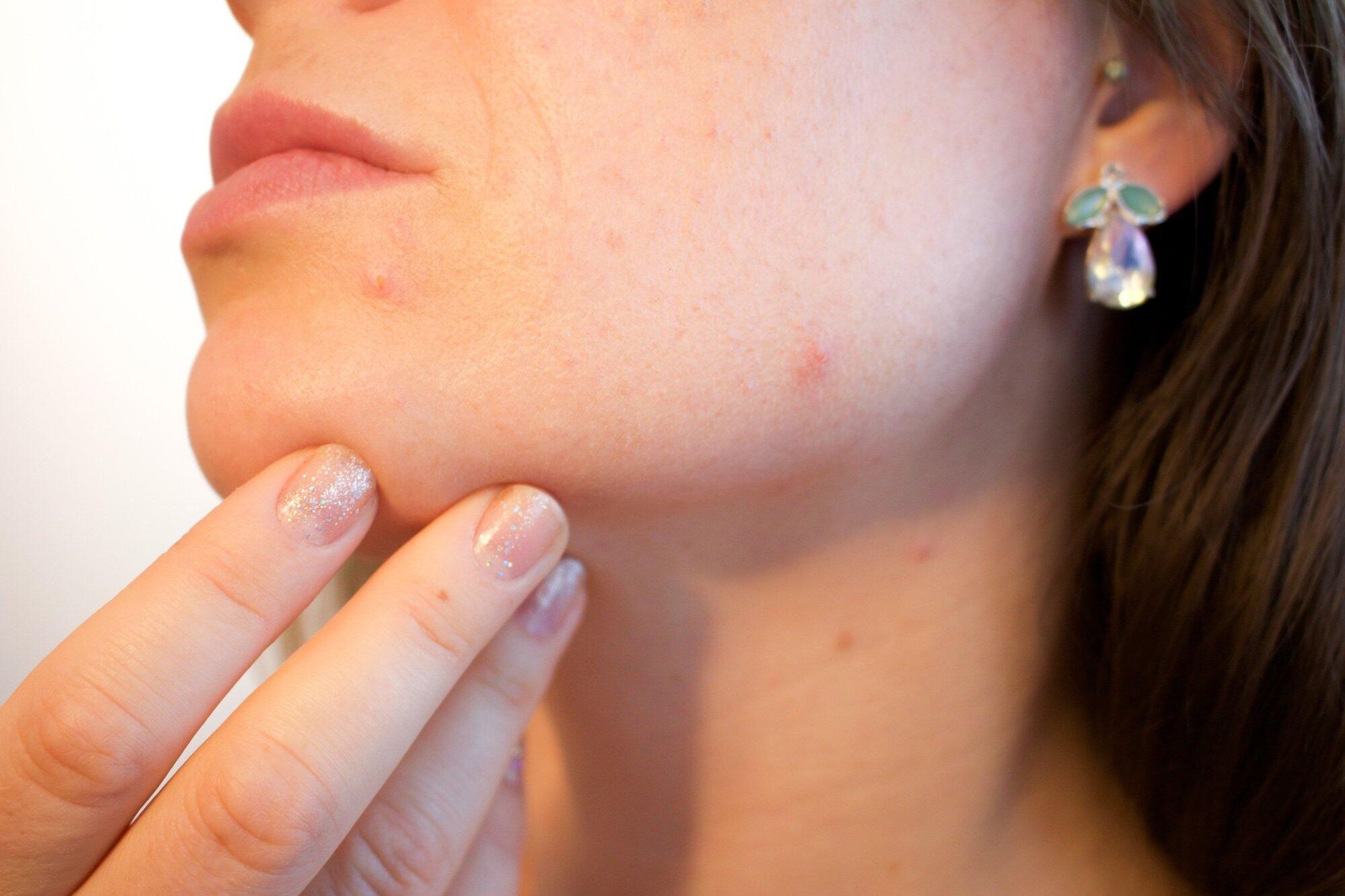 new acne medication